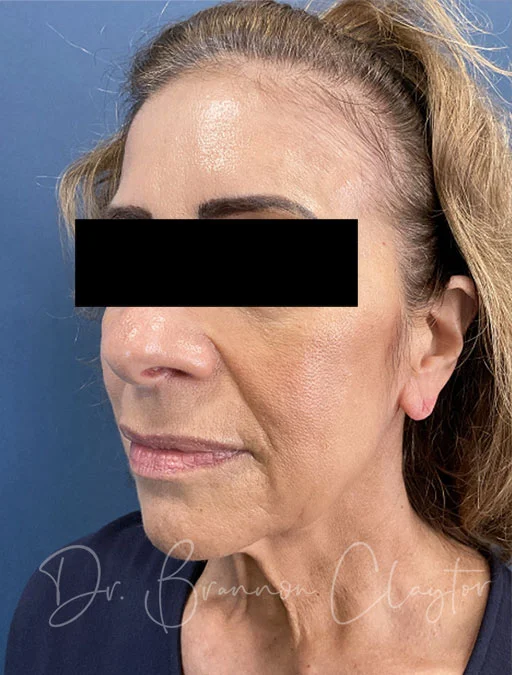 facelift-deep-plane-50780b-before
