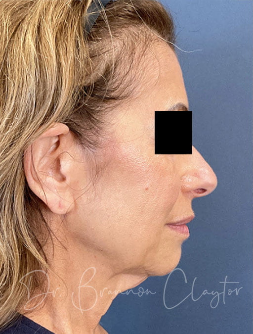 Facelift