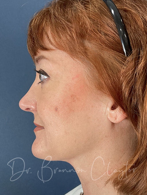 MyEllevate Neck Lift