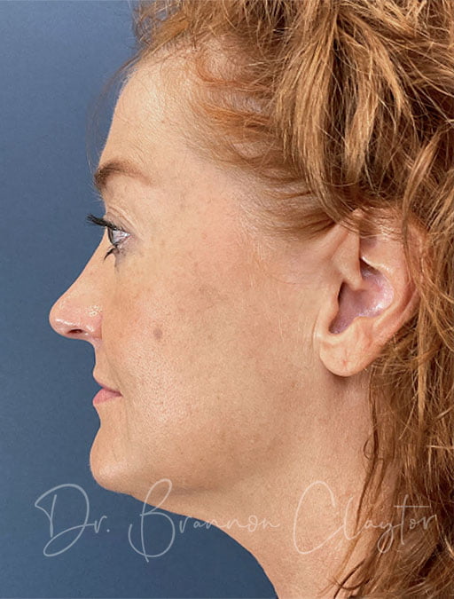 MyEllevate Neck Lift