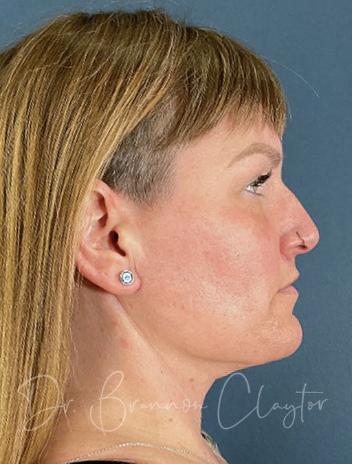 MyEllevate Neck Lift