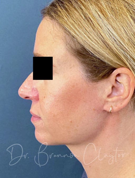 MyEllevate Neck Lift