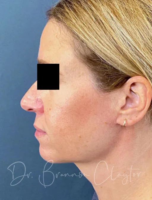 MyEllevate Neck Lift