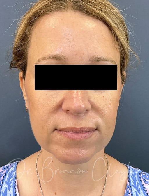 necklift-MyEllevate-44308a-after-3x-cnclaytor