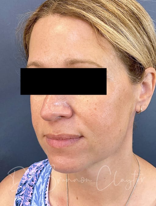 necklift-MyEllevate-44308b-after-3x-cnclaytor