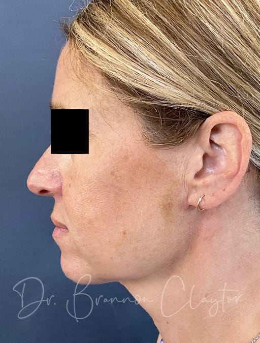 MyEllevate Neck Lift