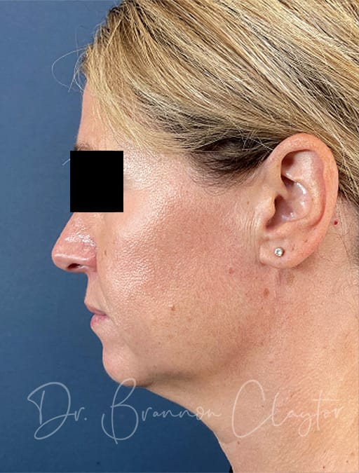 MyEllevate Neck Lift