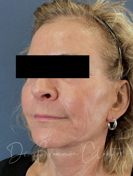 MyEllevate Neck Lift