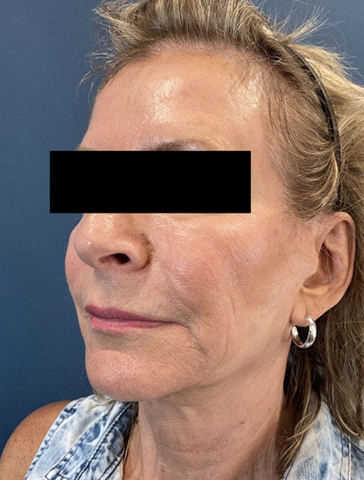 MyEllevate Neck Lift