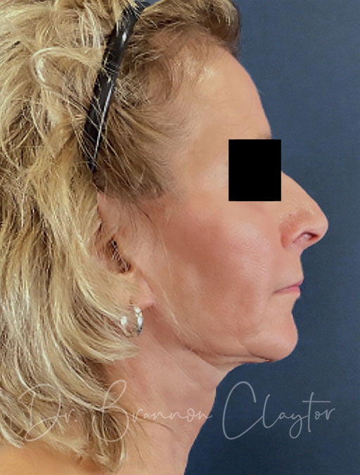 MyEllevate Neck Lift