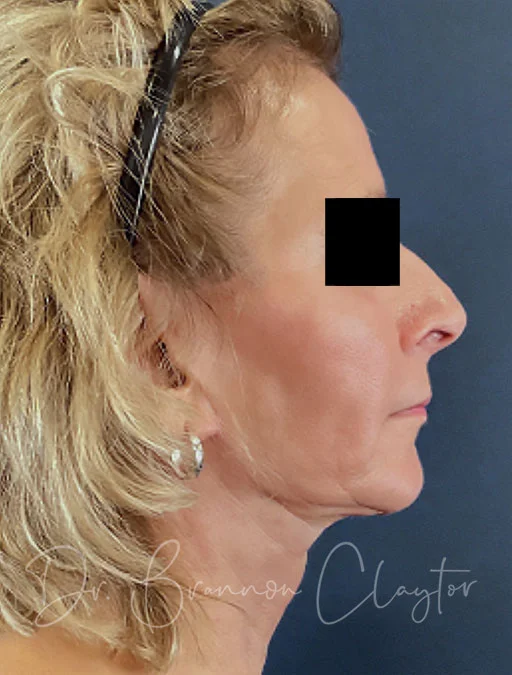 MyEllevate Neck Lift