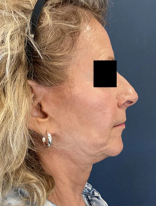 MyEllevate Neck Lift
