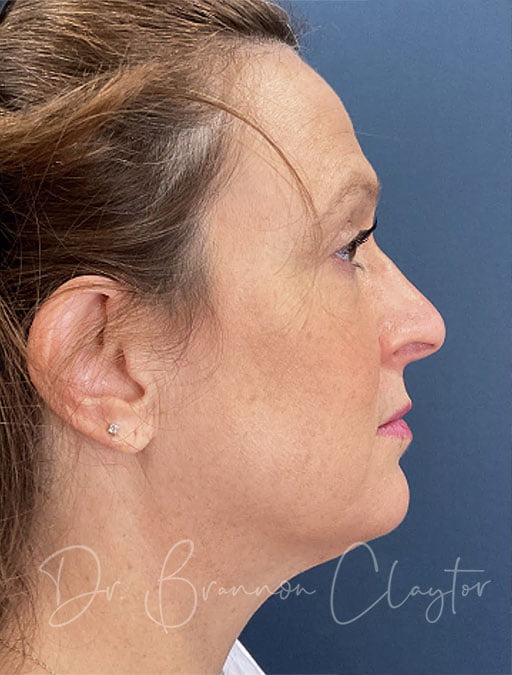 MyEllevate Neck Lift