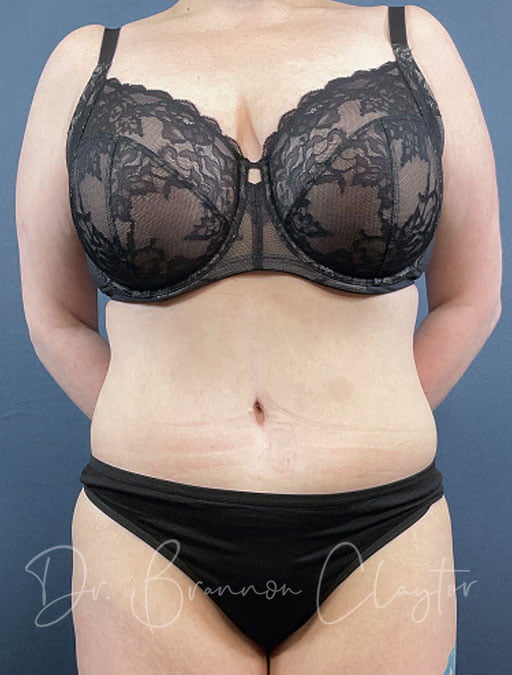Tummy Tuck with Liposuction