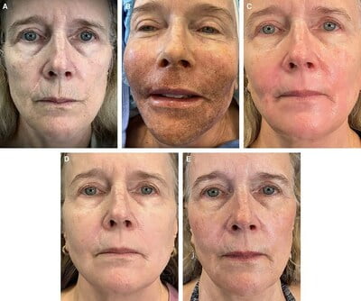 Patient photos showcasing results from Dr. Claytor's LaMiNa non-surgical facial rejuvenation