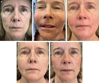 Patient photos showcasing results from Dr. Claytor's LaMiNa non-surgical facial rejuvenation