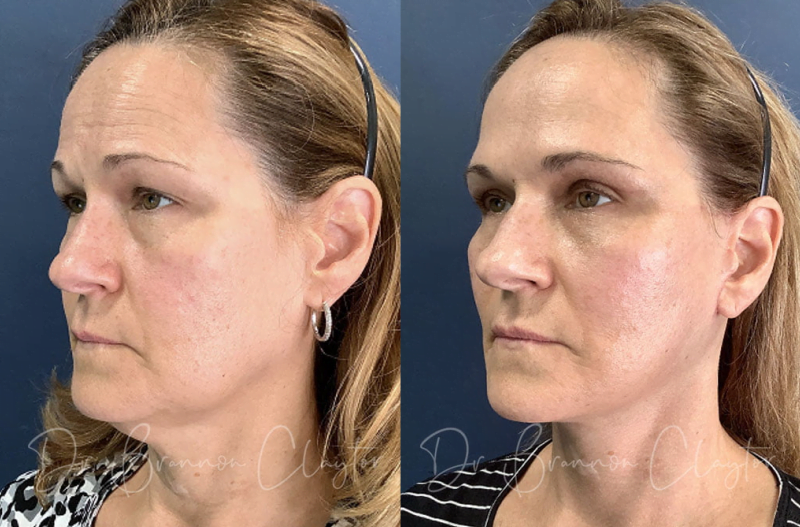 Real patient of Dr. Claytor's shown before and after facelift, neck lift and facial fat grafting