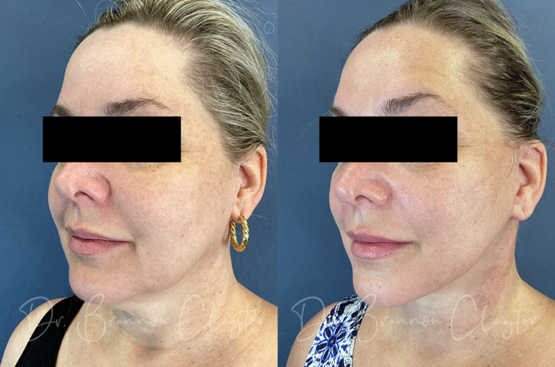 Real patient of Dr. Claytor's shown before and after deep plane facelift and neck lift