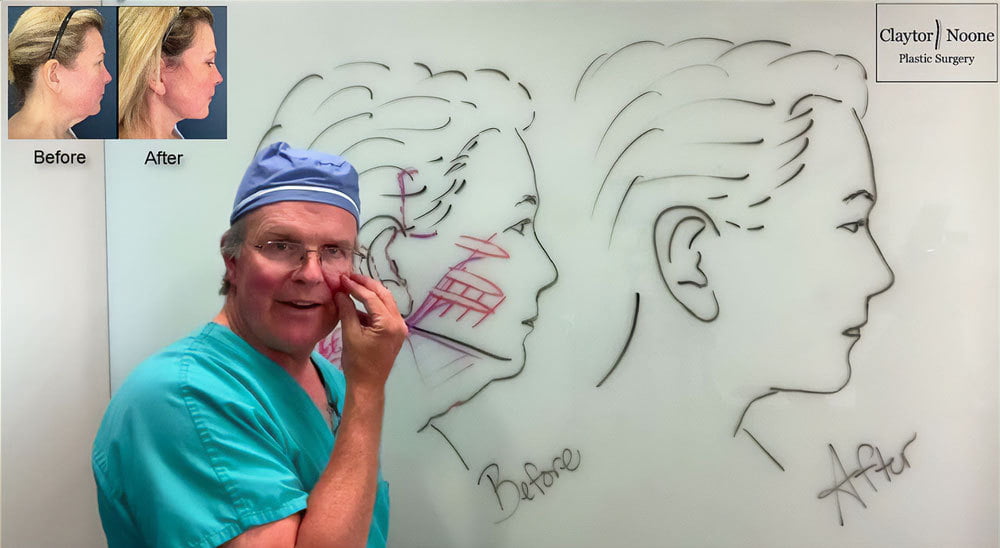 Philadelphia facelift surgeon in his viral video explaining deep plane facelifts