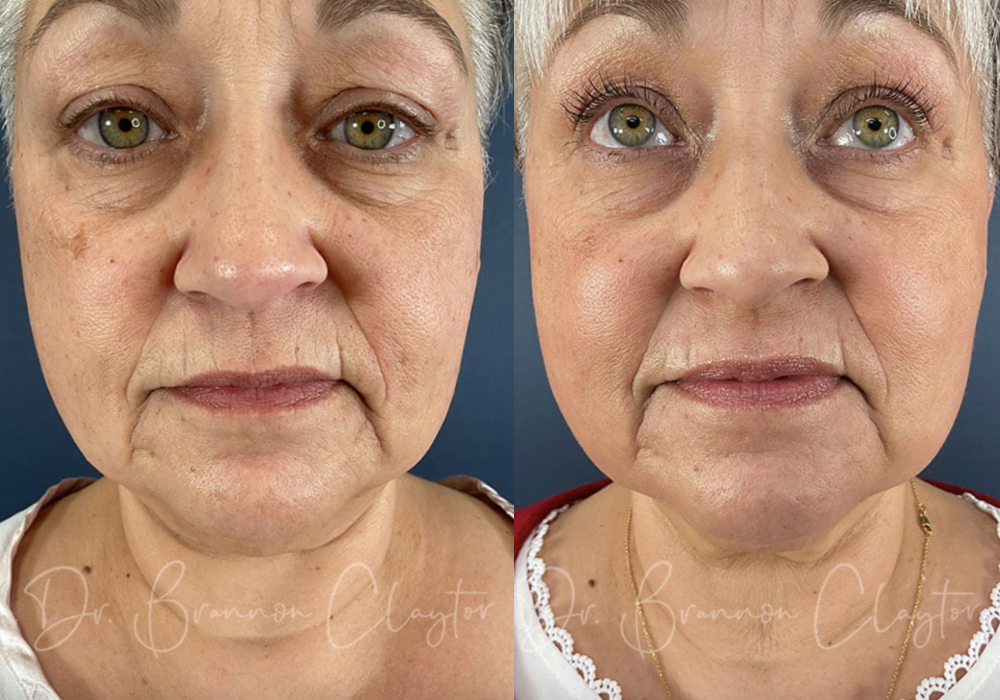 Patient shown before and 6 weeks after LaMiNa treatment.