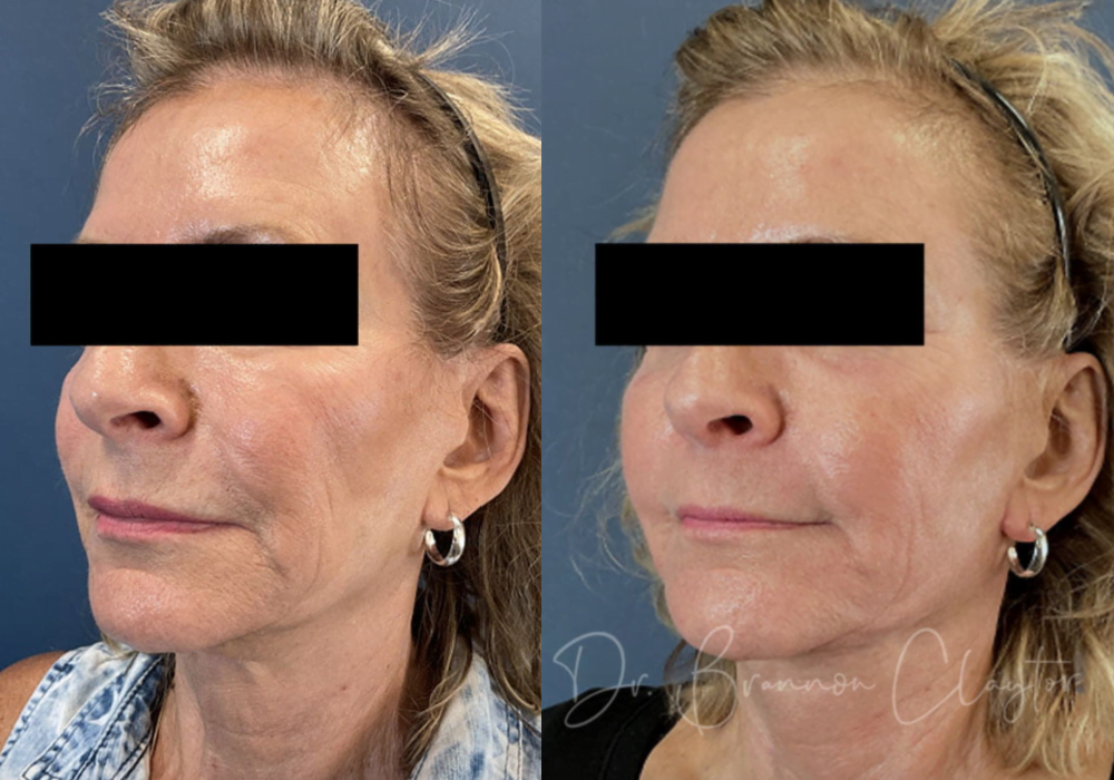 CO2 Laser Necklift - £300 Off!