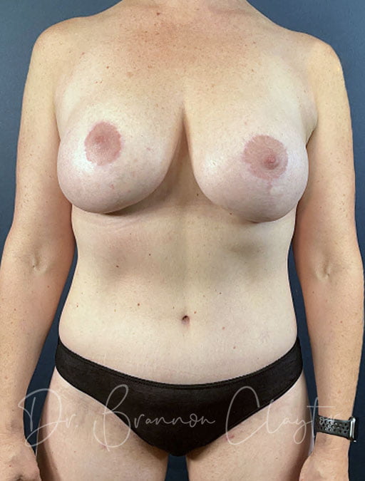 Belt Lipectomy & Breast Augmentation