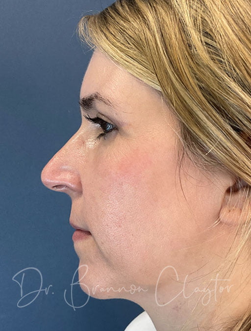 eyelid surgery photo after