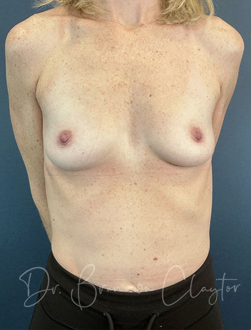 Breast Augmentation