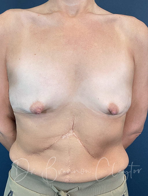 Breast Augmentation