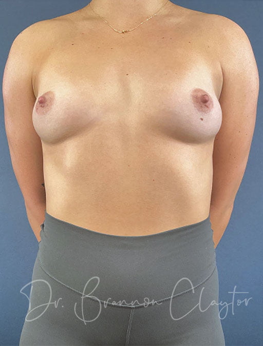 Breast Augmentation