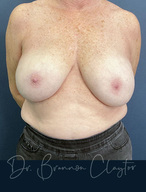 Liposuction Breast Reduction