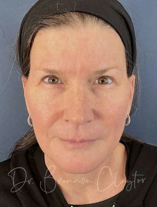 facelift-deep-plane-51311a-after