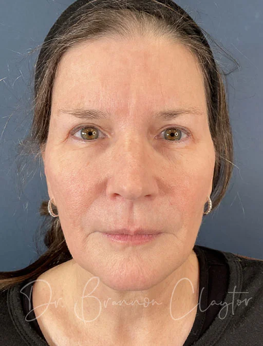 facelift-deep-plane-51311a-before
