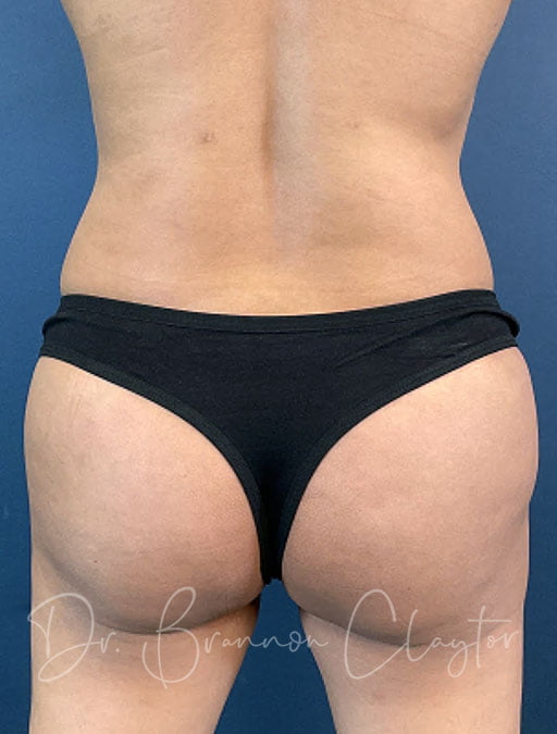 Liposuction & Fat Transfer to Buttocks