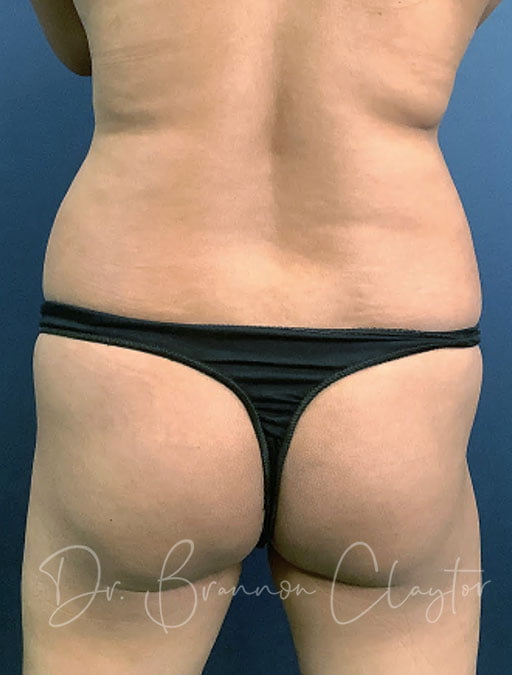 Liposuction & Fat Transfer to Buttocks