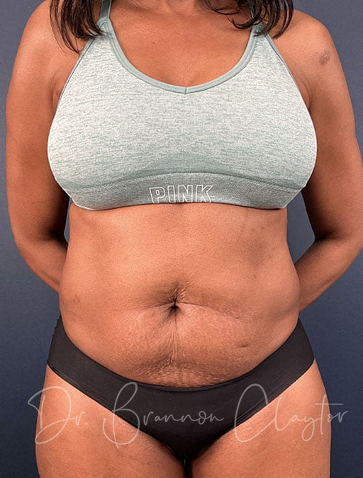 Mini Tummy Tuck with Liposuction