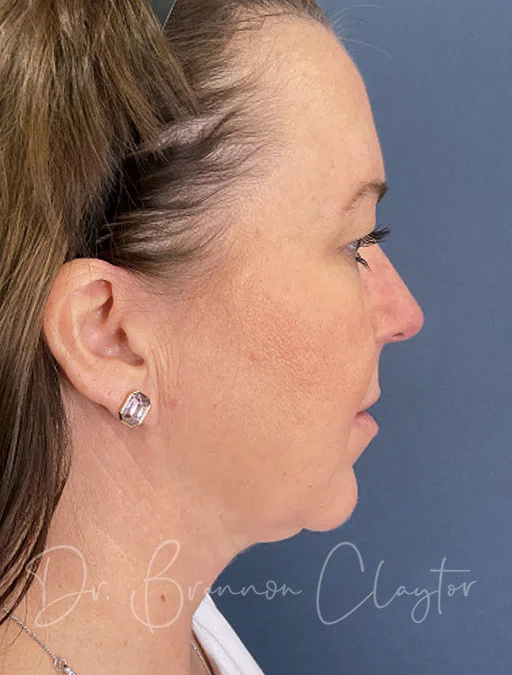 MyEllevate Necklift