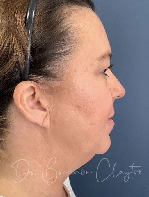 MyEllevate Necklift