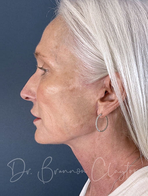 MyEllevate Neck Lift