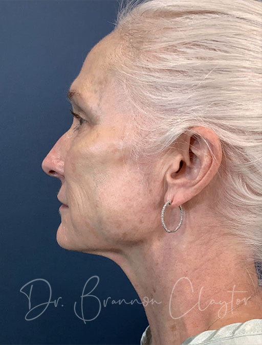 MyEllevate Neck Lift