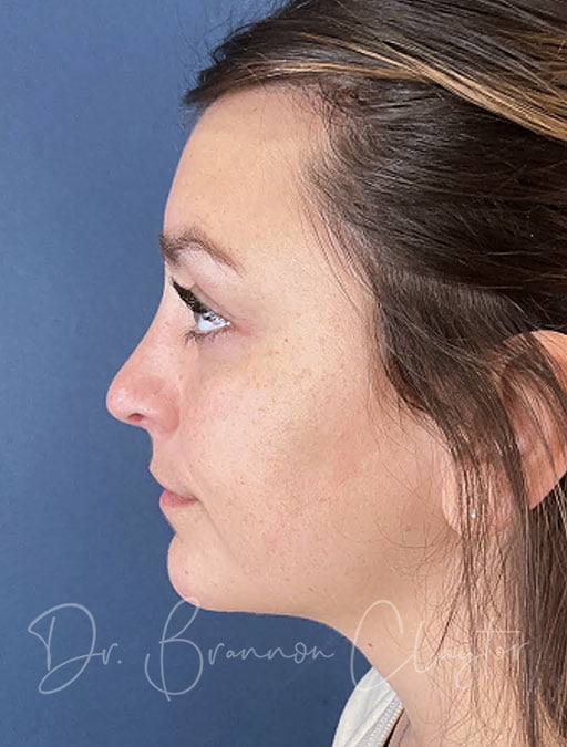 Rhinoplasty