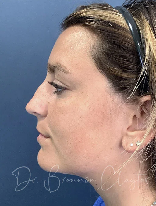 Rhinoplasty