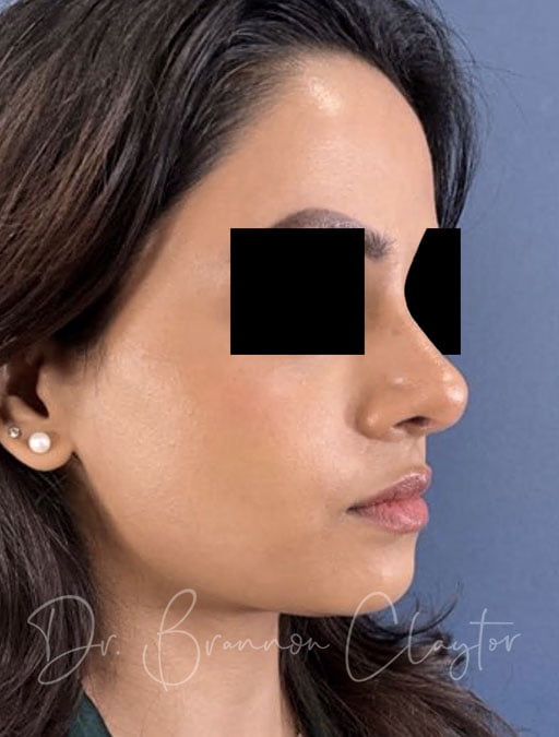 Rhinoplasty