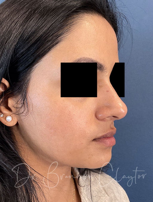 Rhinoplasty