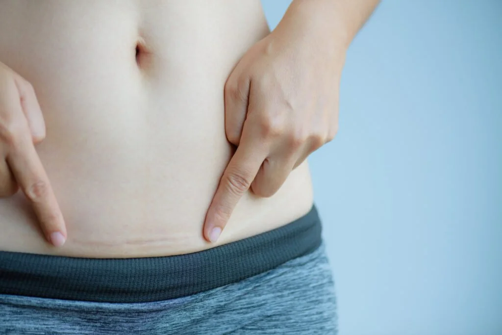 Woman touching surgical scars that haver healed