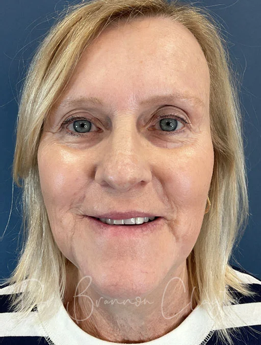 skin-resurfacing-btl-50385a-after