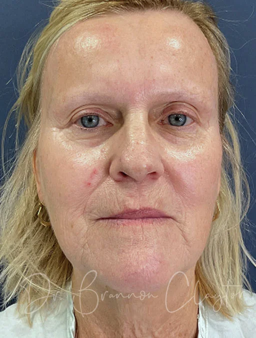 skin-resurfacing-btl-50385a-before