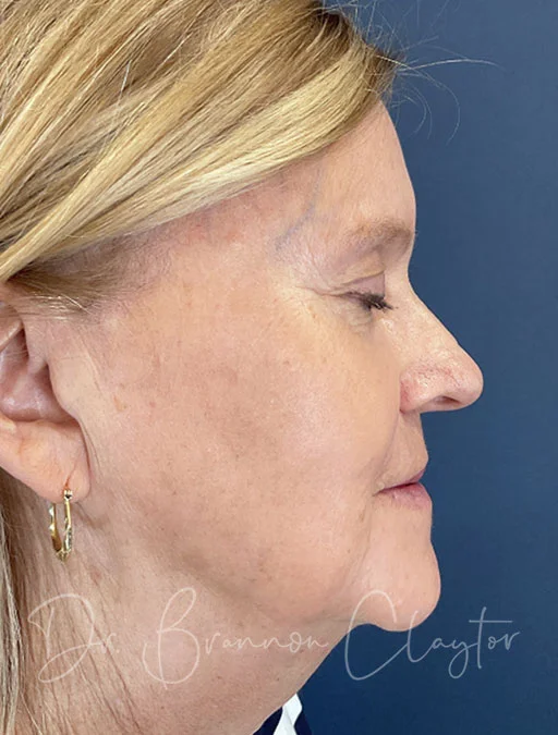 skin-resurfacing-btl-50385c-after