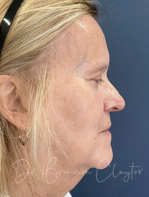 skin-resurfacing-btl-50385c-before