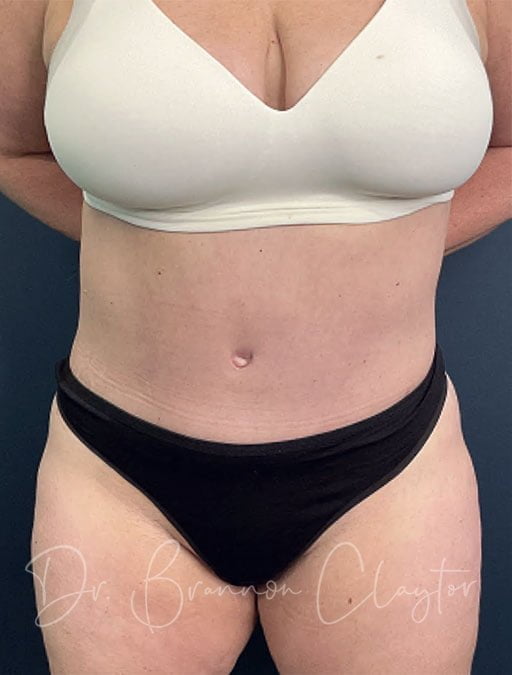 Tummy Tuck Post op photo